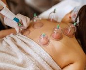 Woman Placing Glass Cups On A Man's Back